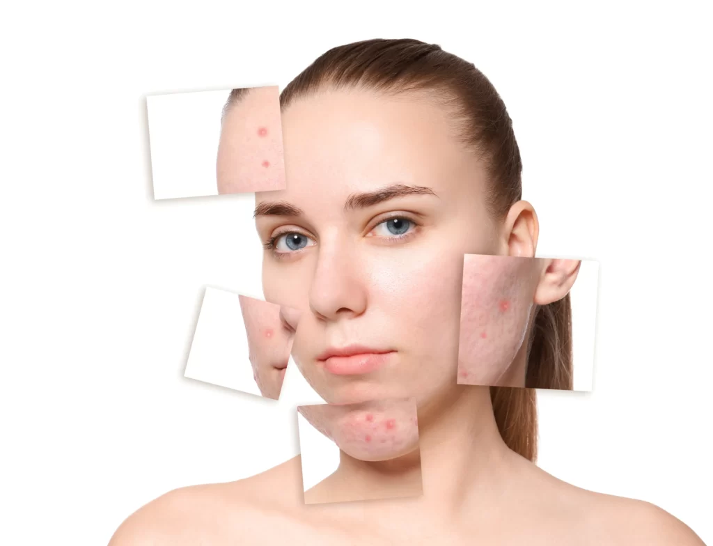What emotional impact does Acne have on you? 1